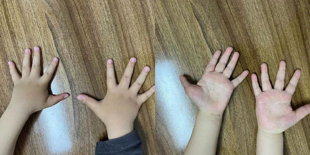三岁上海男孩拇指畸形，到中山进行“移花接木”手术完美修复