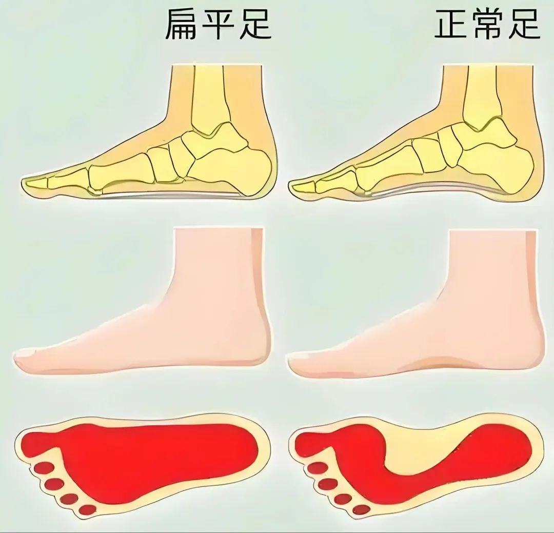 扁平足与高弓足科普指南，别让双脚 “畸形” 了你的人生