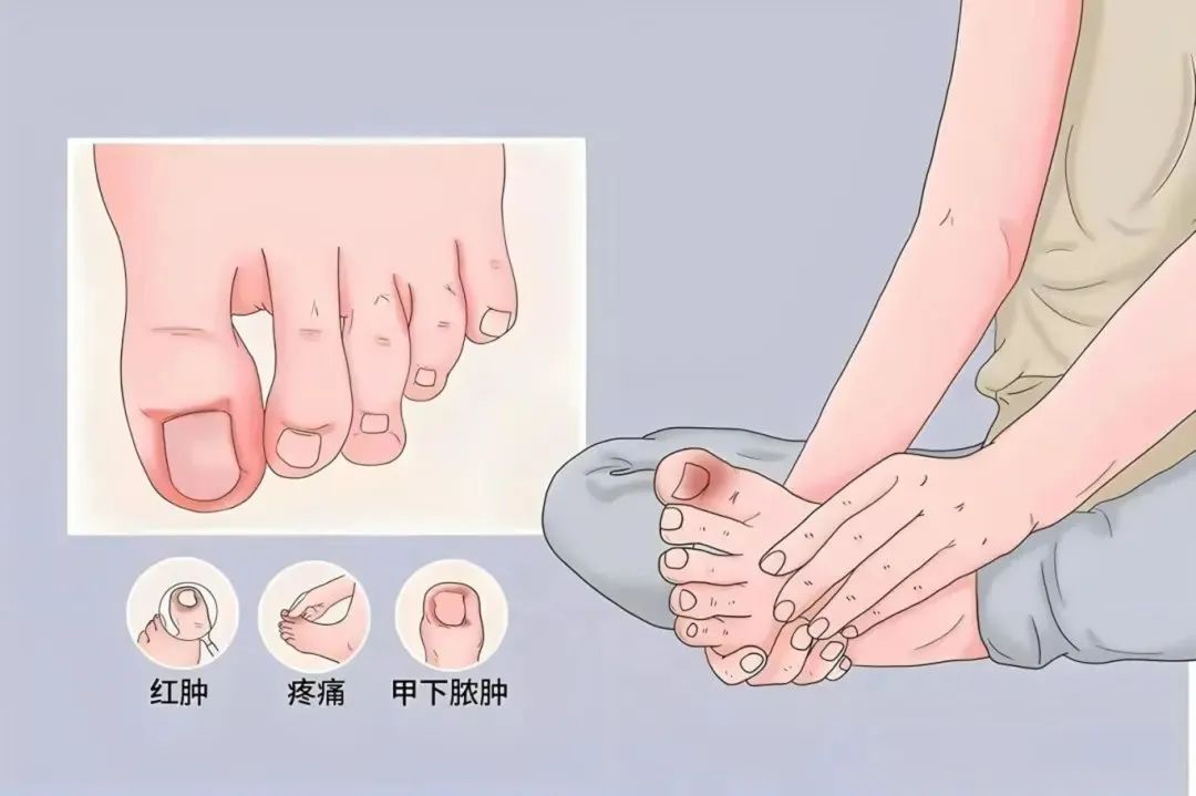 甲沟炎：小伤口背后的大麻烦